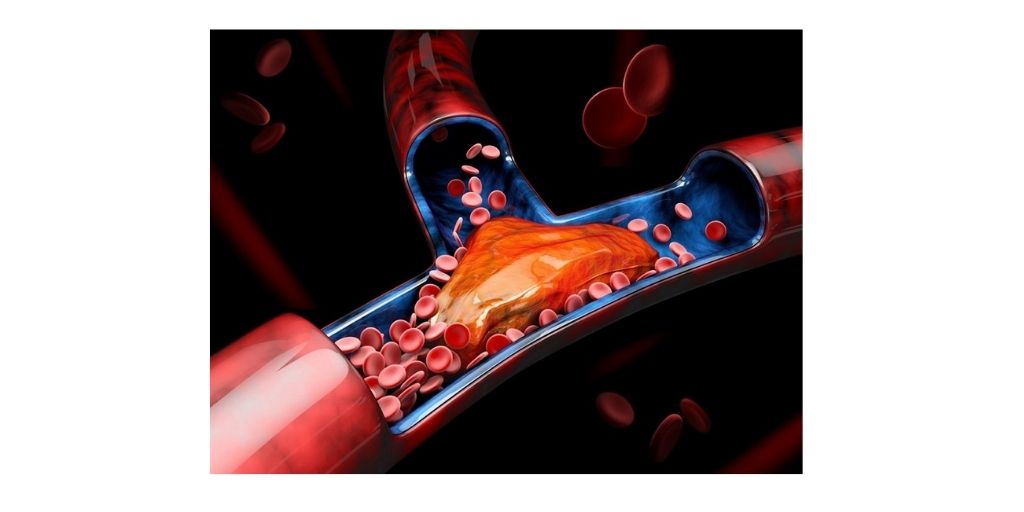 Deep Vein Thrombosis - Diagnosis and Treatment