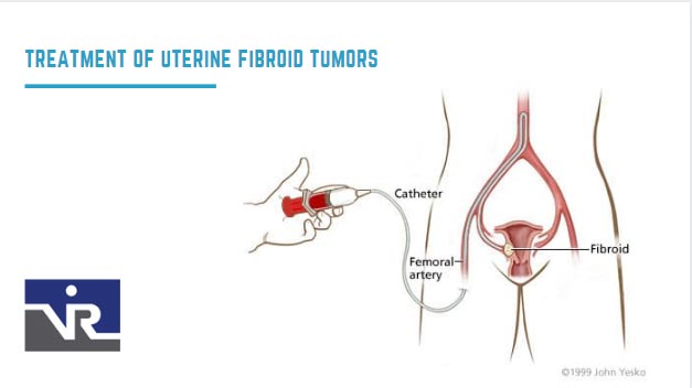 Uterine Fibroids