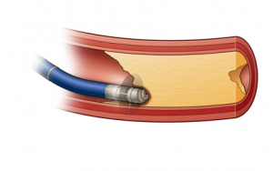 Laser-guided artery drill