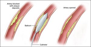 Balloon Angioplasty